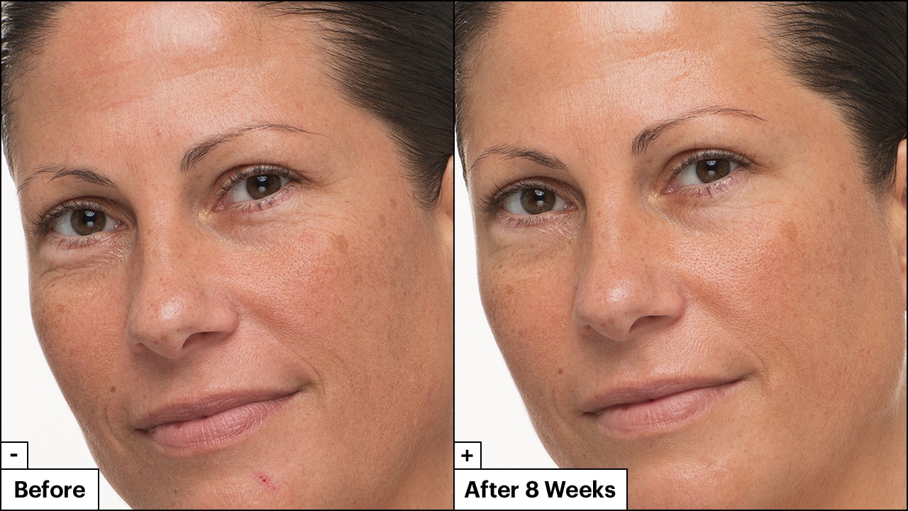 Close up of woman's face shows significant reduction in fine lines and wrinkles in her skin before and after 8 weeks.