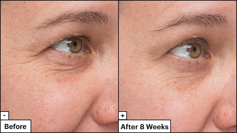 Close up of woman's face shows significant reduction in fine lines & wrinkles in her skin before & after 8 weeks. 